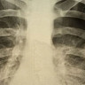 В Саратовской области юноша на рыбалке напоролся на камыш и едва не погиб